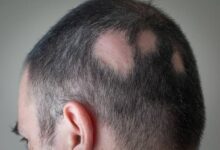 Alopecia areata causing patchy hair loss on scalp