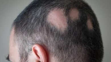Alopecia areata causing patchy hair loss on scalp