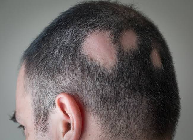 Alopecia areata causing patchy hair loss on scalp